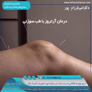 درمان آرتروز با طب سوزنی - دکتر فرزام پور