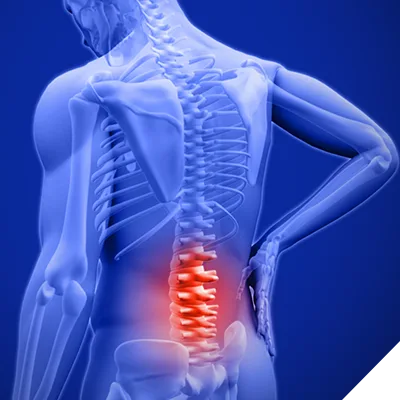 آرتروز گردن و کمر