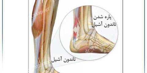 تاندون آشیل
