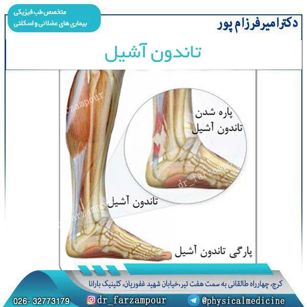 تاندون آشیل