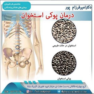 درمان پوکی استخوان- دکتر امیر فرزام پور