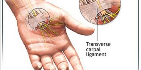 درمان چسبندگی عصب دست و درمان - دکتر امیر فرزام پور