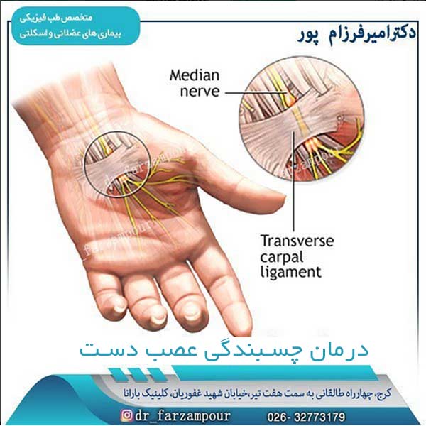 درمان چسبندگی عصب دست