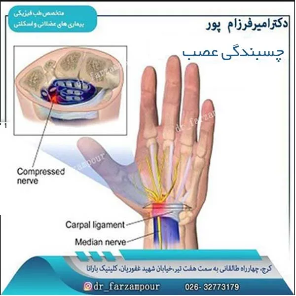 چسبندگی عصب