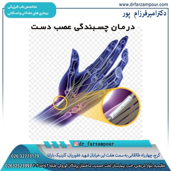 درمان چسبندگی عصب دست - دکتر امیر فرزام پور