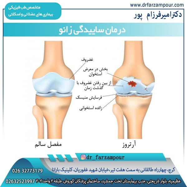 عکس درمان ساییدگی زانو - دکتر فرزام پور