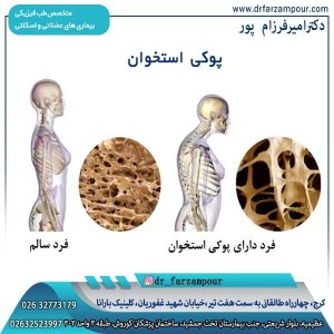 پوکی استخوان - دکتر فرزام پور