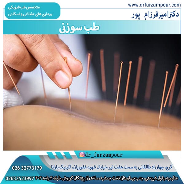 درمان با طب سوزنی 
