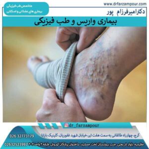 بیماری واریس و طب فیزیکی