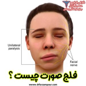 فلج صورت چیست ؟ - دکتر امیر فرزام پور