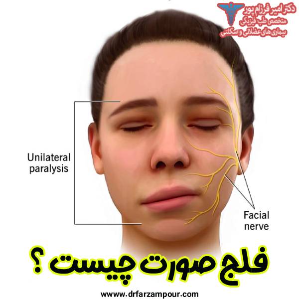 فلج صورت چیست ؟ - دکتر امیر فرزام پور