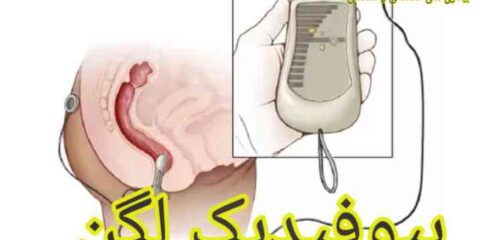 بیوفیدبک لگن - دکتر امیر فرزام پور