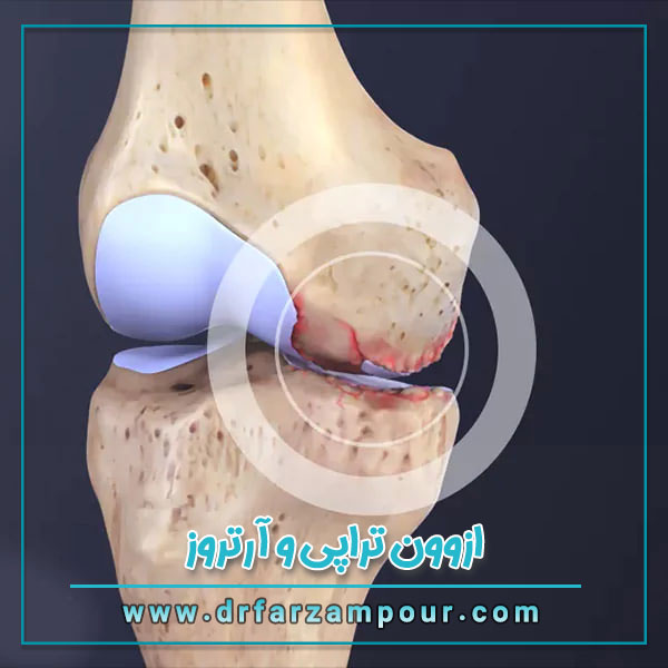 ازون تراپی و آرتروز