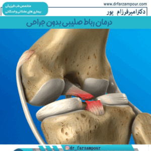 درمان رباط صلیبی بدون جراحی