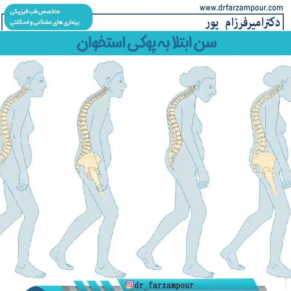 سن پوکی استخوان