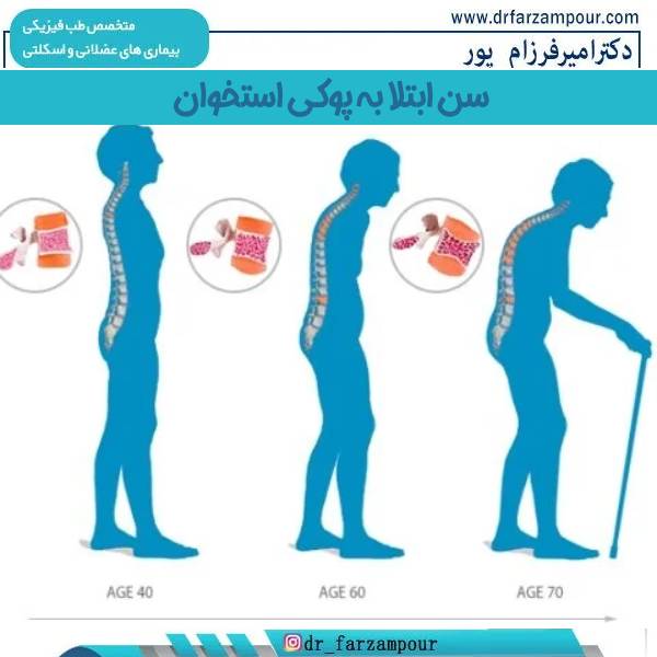سن پوکی استخوان