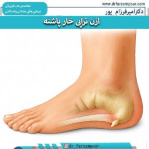 ازن تراپی خار پاشنه